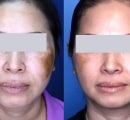 A patient's results before and after laser melasma treatment.