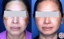 melasma-laser-treatment-before-and-after2