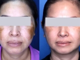A patient's results before and after laser melasma treatment.