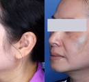 The results of melasma laser treatment before and after