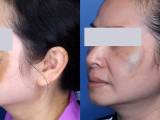 The results of laser treatment for melasma