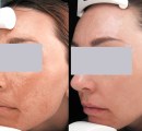 Laser treatment for melasma on the  face.