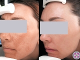 Laser treatment for melasma on the  face.
