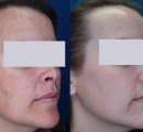 Laser treatment for melasma before and after for light skin.