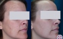 Laser treatment for melasma before and after for light skin