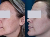 A patient's results before and after melasma treatment.