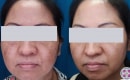 melasma-treatment-before-and-after-8