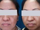 A patient's results before and after melasma treatment.