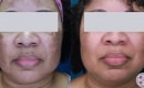 Laser treatment for melasma before and after for darker skin