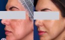 Laser treatment for melasma before and after