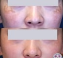 A patient's results before and after melasma treatment with lasers.
