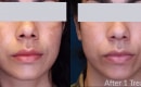 melasma-treatment-with-lasers-before-after-2