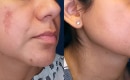 melasma-treatment-with-lasers-before-after