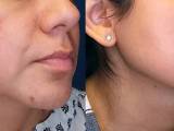 Before and after laser treatment for melasma