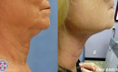 Before and After NeckTite Neck and Jowl Tightening