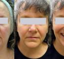 Before and After Skin Tightening of the Neck and Jowls