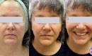 Before and After Skin Tightening of the Neck and Jowls