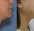 Before and After a Non-Surgical Neck Lift