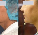 Before and After Skin Tightening of the Turkey Neck