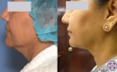 Before and After Skin Tightening of the Turkey Neck