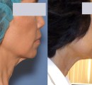 Before and After Skin Tightening of the Neck
