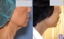 Before and After Skin Tightening of the Neck