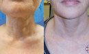 Before and After NeckTite Neck Tightening Procedure