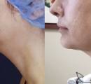 Neck Tightening Before and After
