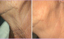 Before and After Laser Skin Tightening