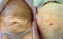 Before and After the Abdomen Tight Procedure