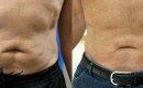 Before and After the Abdomen Tight Procedure