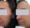 SpectraLift™ Laser Facelift Before and After