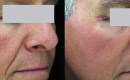 Before and After SpectraLift Non Surgical Laser Facelift