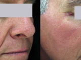 Before and After SpectraLift™  Non Surgical Laser Facelift