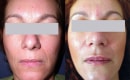 Before and After SpectraLift Non Surgical Laser Facelift