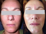 Before and After SpectraLift™ Non Surgical Laser Facelift