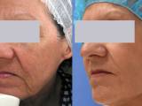 SpectraLift™ Laser Facelift Before and After