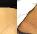 1_before-and-after-treatment-with-lasers-to-reduce-stretch-marks