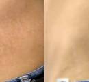 1_stretch-mark-removal-on-man-love-handles-with-lasers