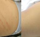 laser-treatment-for-stretch-marks