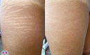 Before and After Stretch Mark Removal on the Thigh