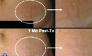 Before and After Stretch Mark Removal on the Abdomen