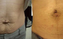 Before and After Stretch Mark Removal and Skin Tightening