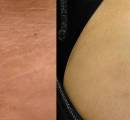 Before and After Laser Stretch Mark Removal on the Thigh