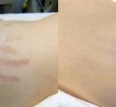 stretch-mark-removal-laser-treatment-before-and-after