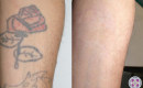 Before and After Laser Tattoo Removal on the Leg