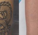 Before and After Laser Tattoo Removal on the Calf