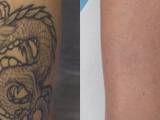 Before and After Laser Tattoo Removal on the Calf
