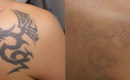 Before and After Laser Tattoo Removal on the Shoulder