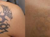 Before and After Laser Tattoo Removal on the Shoulder
